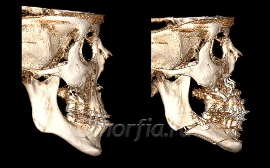 beforeafter_side