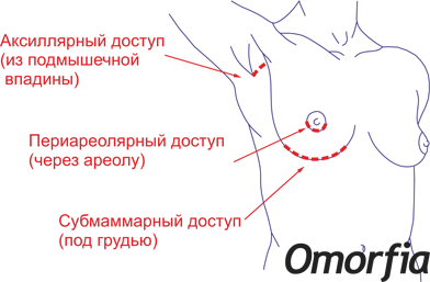 Доступы установки имплантов