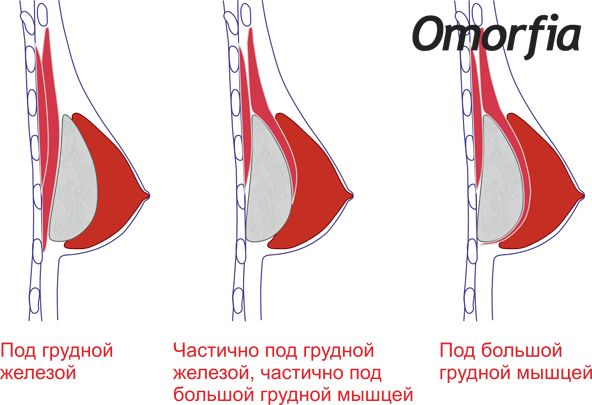 Способы установки имплантатов
